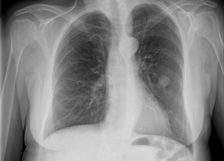 Akciğerde kitle kaç cm olursa tehlikelidir?