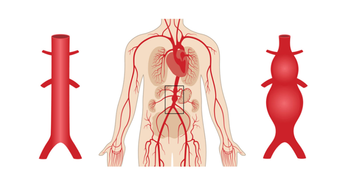 aort anevrizması belirtileri nelerdir?